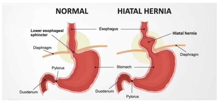 Diagram comparing a normal stomach and esophagus with a hiatal hernia, where part of the stomach has moved up through the diaphragm into the chest.