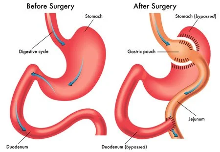 Diagram comparing the stomach and digestive system before and after Roux-en-Y gastric bypass, showing the small pouch and the rerouted small intestine.