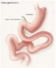 Diagram of the stomach and upper digestive tract after sleeve gastrectomy.