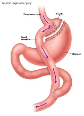 Diagram of gastric bypass anatomy showing the esophagus, the stomach pouch, the small intestine and the bypassed remnant stomach.