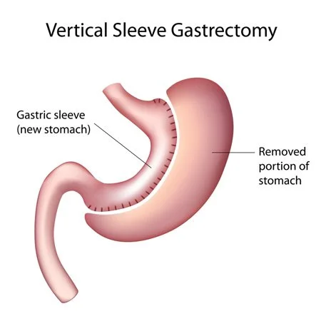 Illustration of a vertical sleeve gastrectomy, showing the narrow tube-shaped stomach remaining after the outer portion is removed.