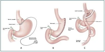 Three diagrams comparing a correctly positioned band with a slipped band and an enlarged stomach pouch.