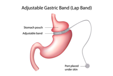Diagram of an adjustable gastric band positioned around the upper stomach, showing the small pouch above the band.