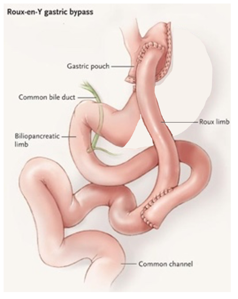 Diagram of Roux-en-Y gastric bypass, showing the stomach pouch and rerouted small intestine.