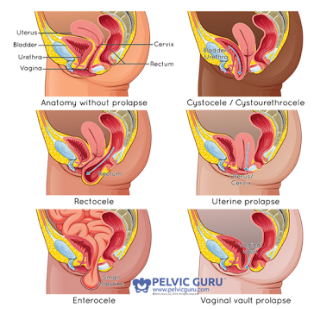 Insights into Pelvic Prolapse, A Pelvic Support Dysfunction: Causes and Treatments