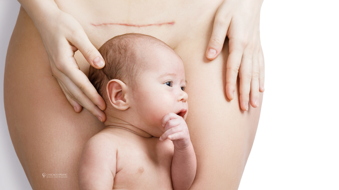 Pelvic Floor Rehabilitation After C-Section: A Route to Recovery