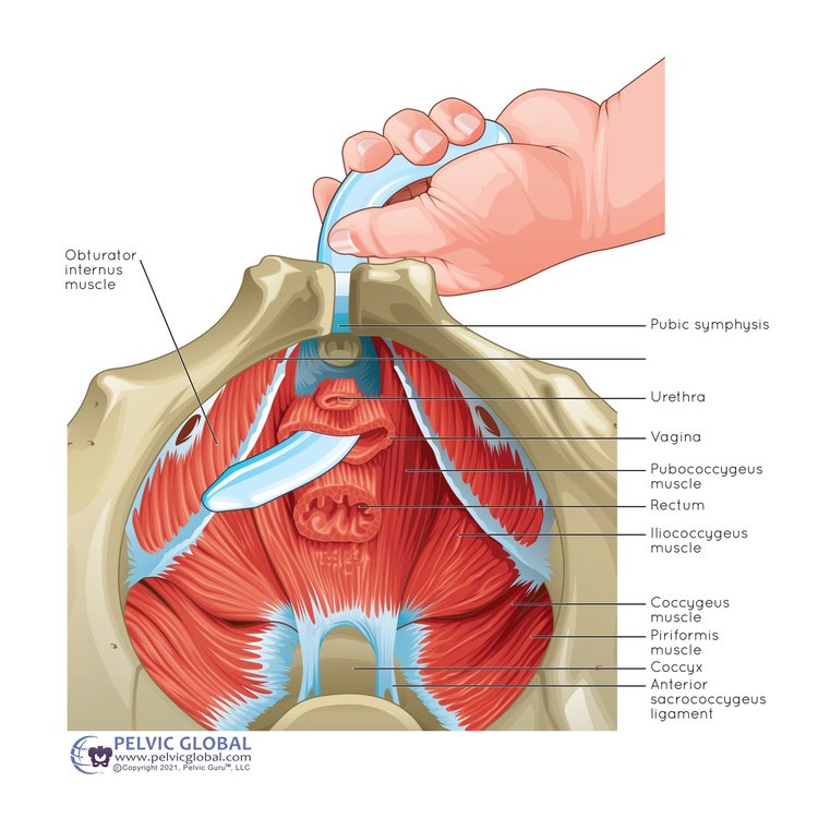 Self Obturator Internus Release: Unlocking Pelvic Relief Through PT