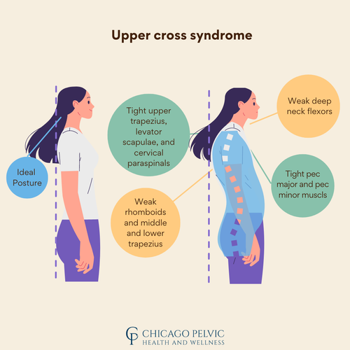 Upper Crossed Syndrome and How Pelvic PT Can Help Correct Muscle Imbalances