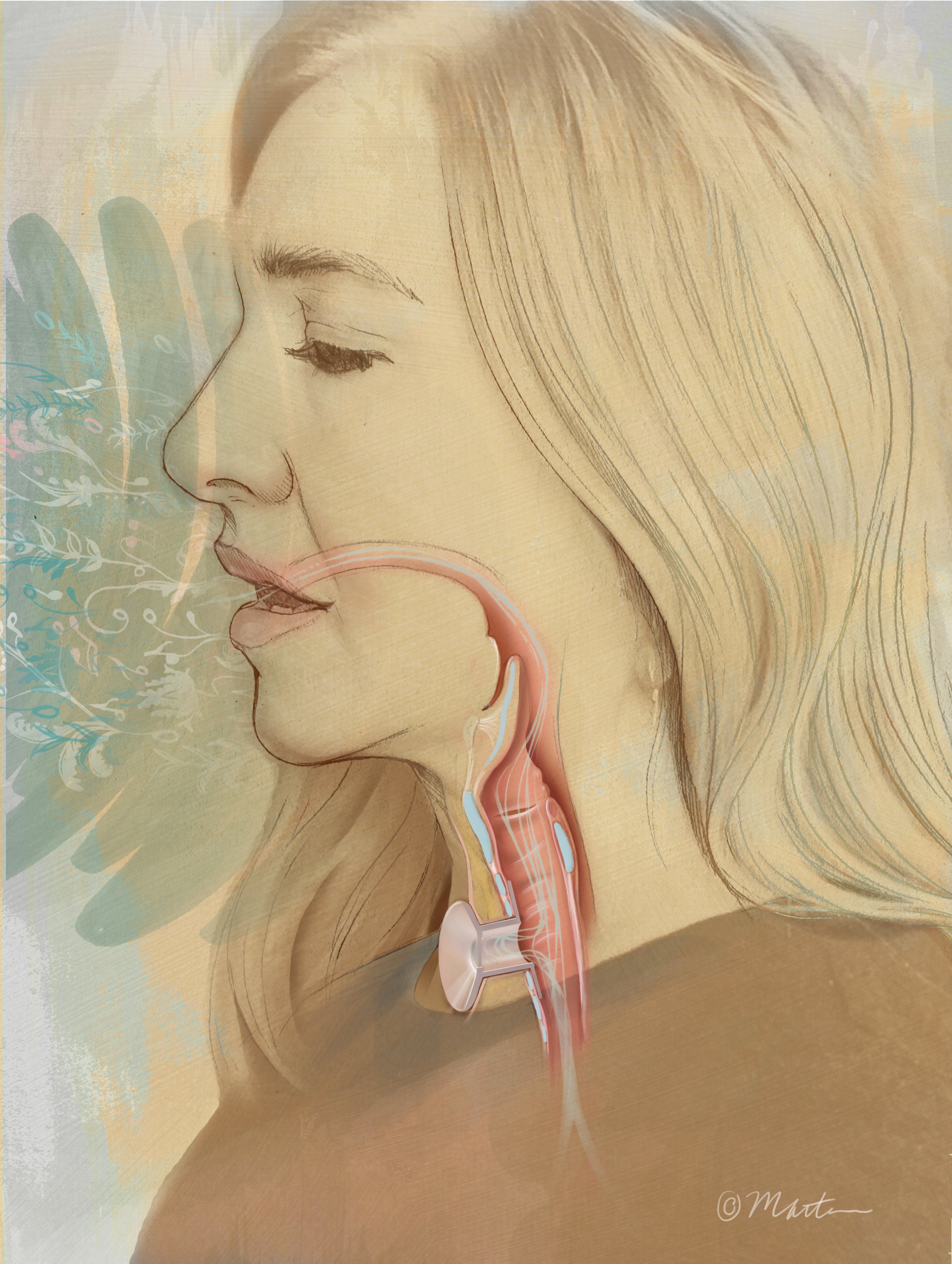 Speech After Tracheostomy