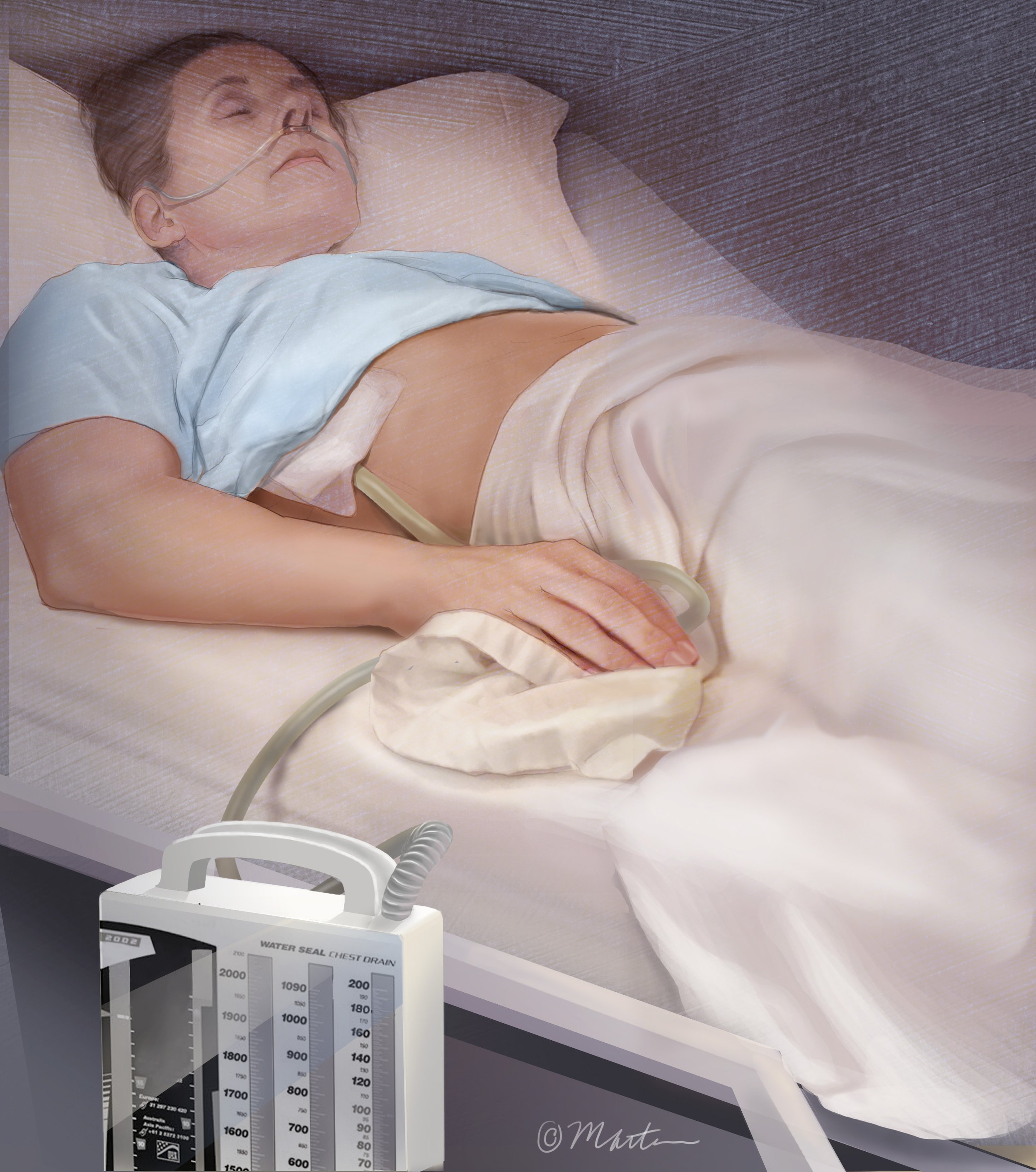 Chest Tube Drainage
