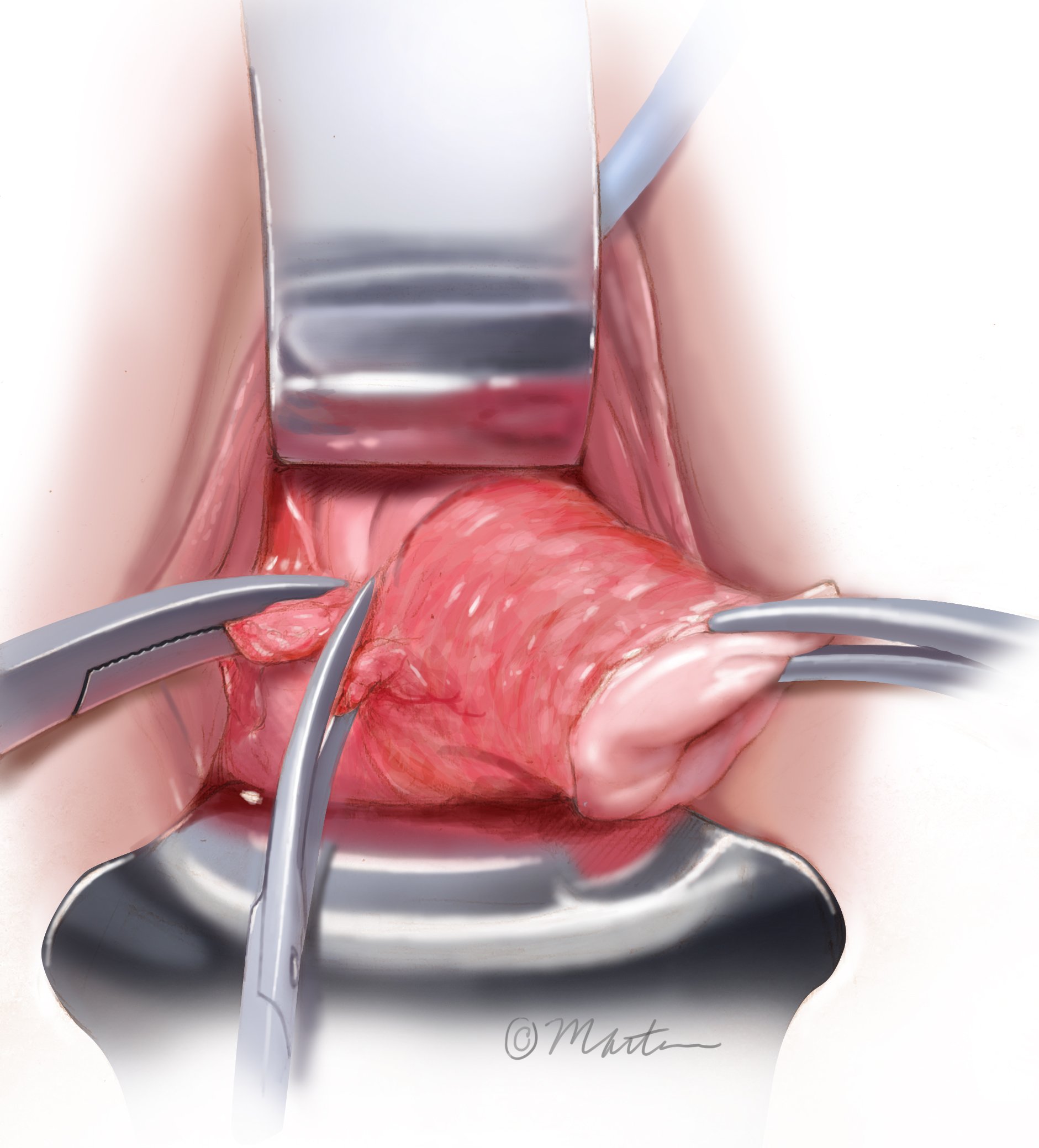 Total Vaginal Hysterectomy