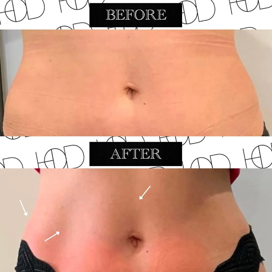 Want a Toned Stomach This Summer?  Unleash the Power of Cryoskin! 🧊✨➖

Our client&rsquo;s Cryoskin Slimming journey was on her abdomen and love handles. These results only took 10 weeks paired with a healthy diet! ❄️💎

Say goodbye to stubborn fat a