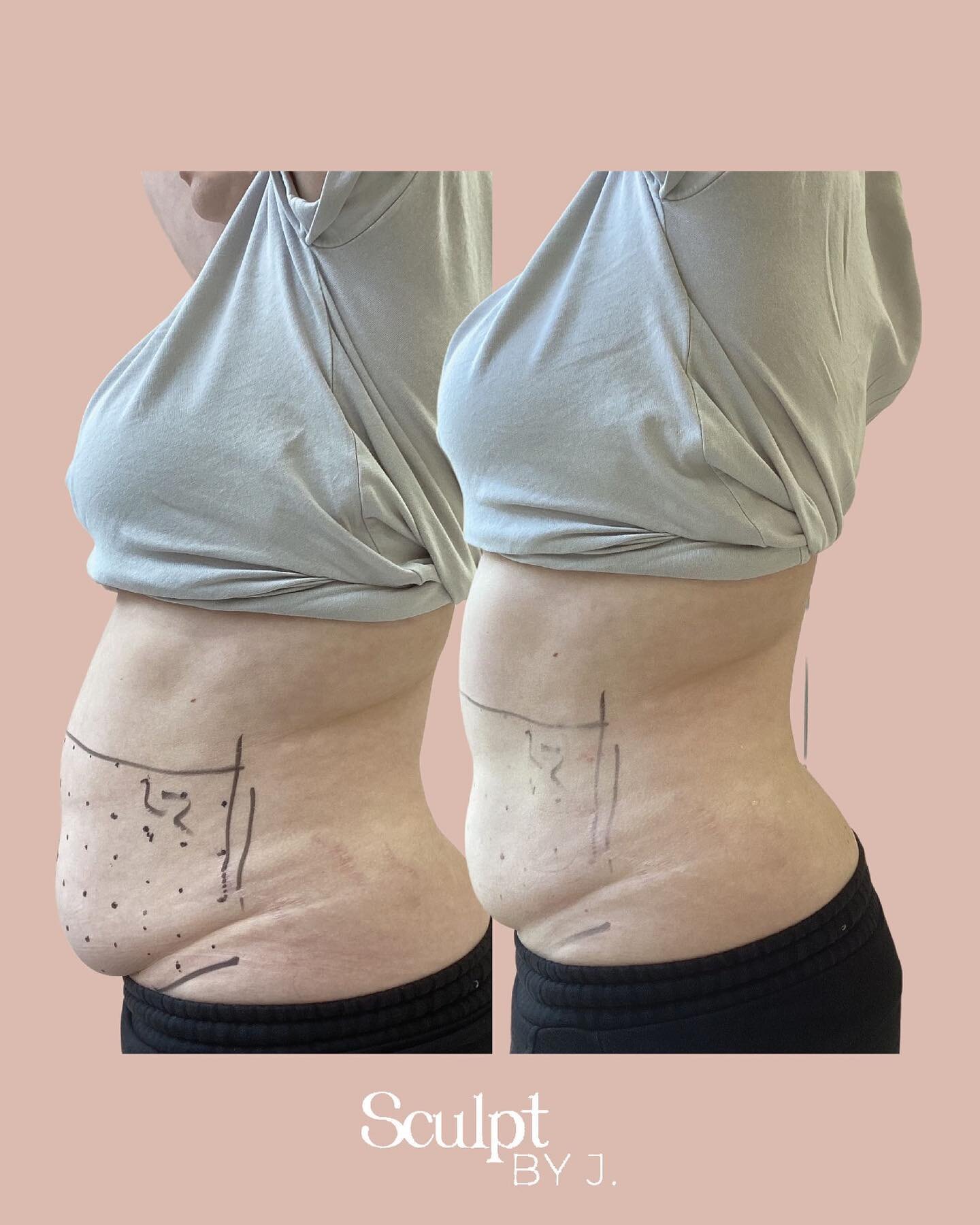 Immediately after one session of LIPOcel 😱

Generally, clients will see results from LIPOcel immediately following their treatment (around 5-15% of overall results are noticed immediately), however the full effect of the treatment will continue to d