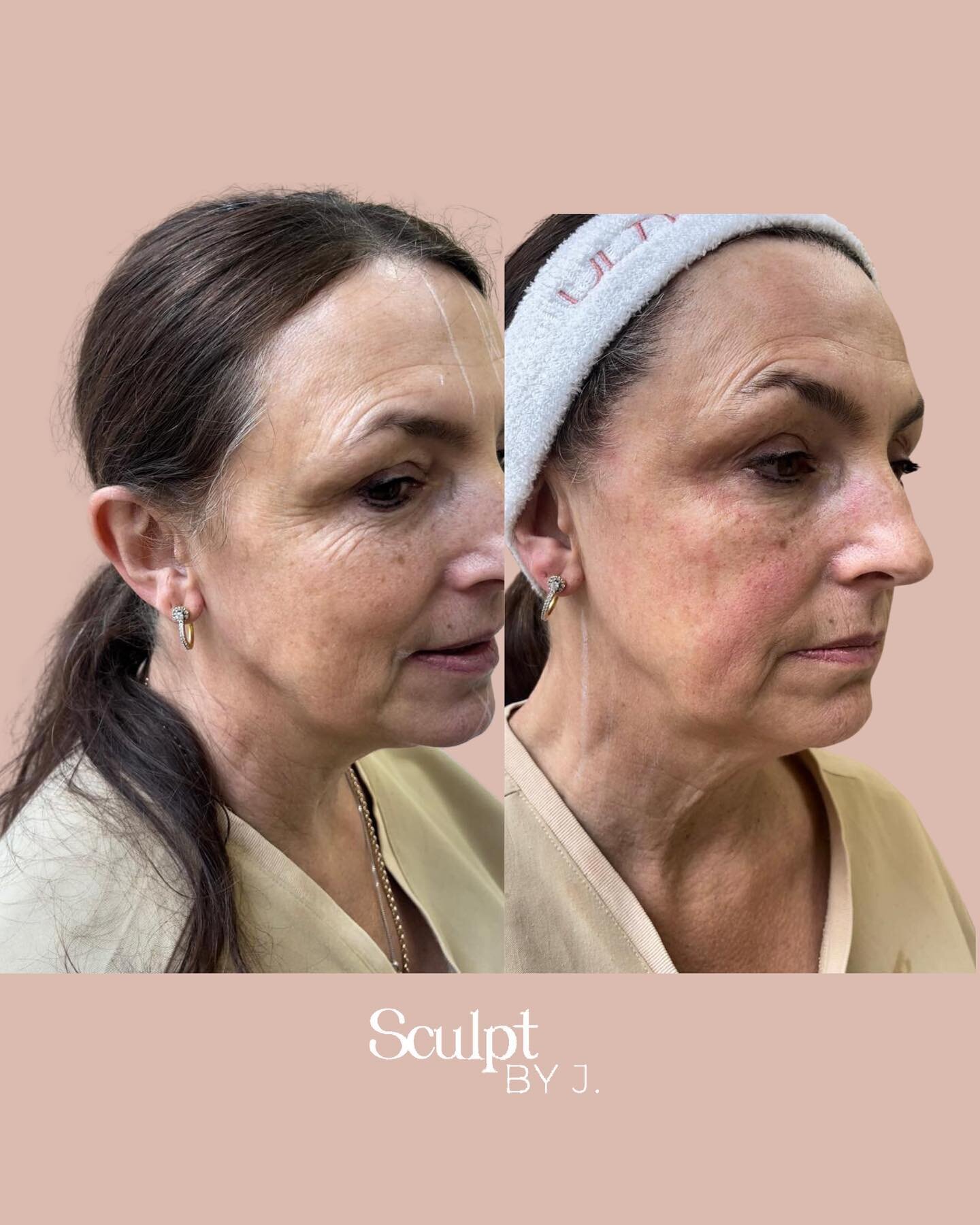 Our Non Surgical Facelift - Hifu Ultracel Q + after ONE session!

Lift, tighten, smooth wrinkles and contour your face and neck with the latest HIFU technology

What is HIFU?

This is a TGA approved medical grade device which delivers completely non-