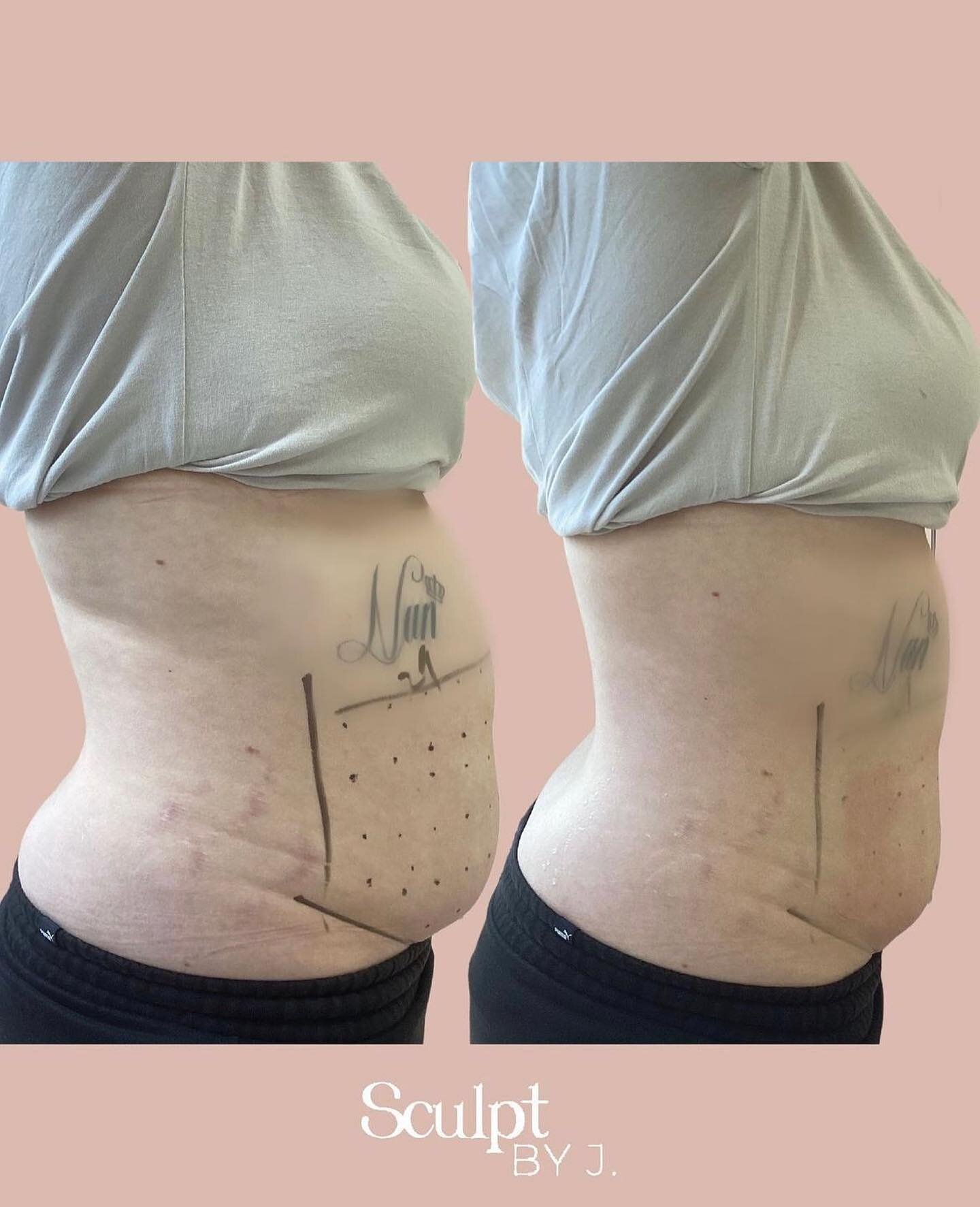 Can you believe this was only 1 session of LIPOCel.

LIPOcel is an innovative TGA approved non-invasive solution for reducing fat and reshaping the body. This clinically proven treatment specifically targets stubborn fat areas.

For best results we r
