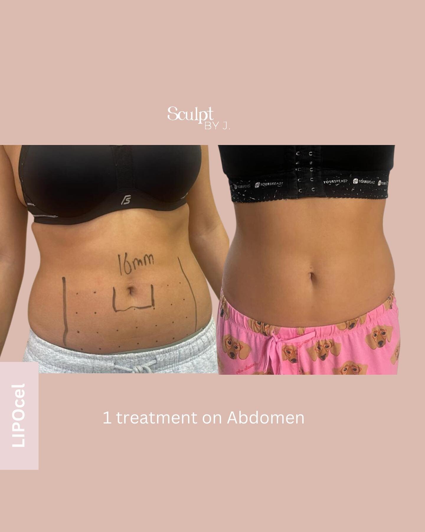 Our clients first session with the revolutionary LIPOcel 👌 the results will only get better over a 12 week period.

If you have stubborn pockets of fat that just don&rsquo;t budge no matter how much time you spend in the gym or watch what you eat, w