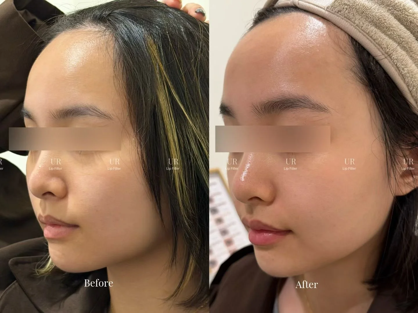 Real Patient Results | Lip Fillers
