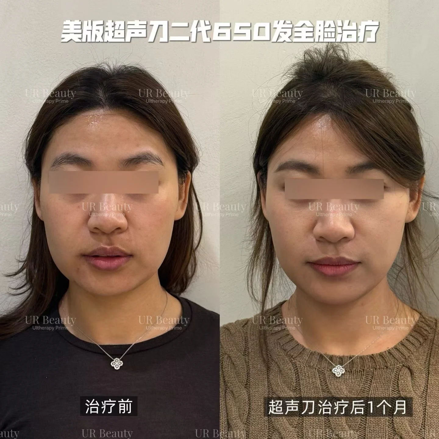 Real Patient Results | Ultherapy Prime