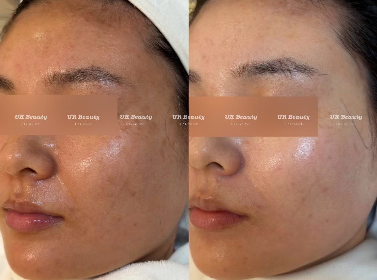 Real Patient Results | Skin Boosters