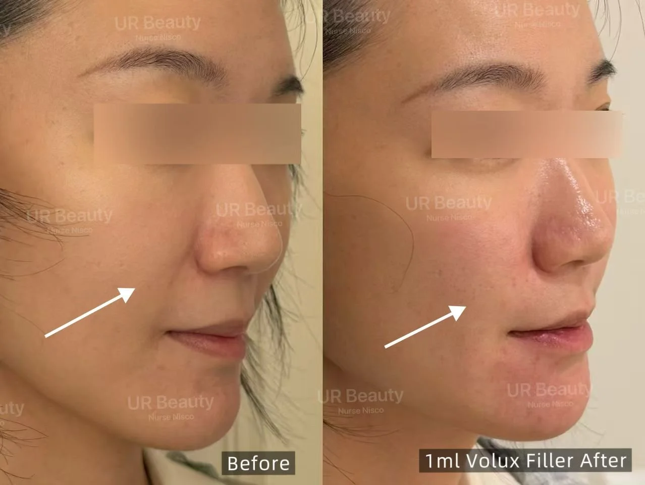 Real Patient Results | Dermal Fillers