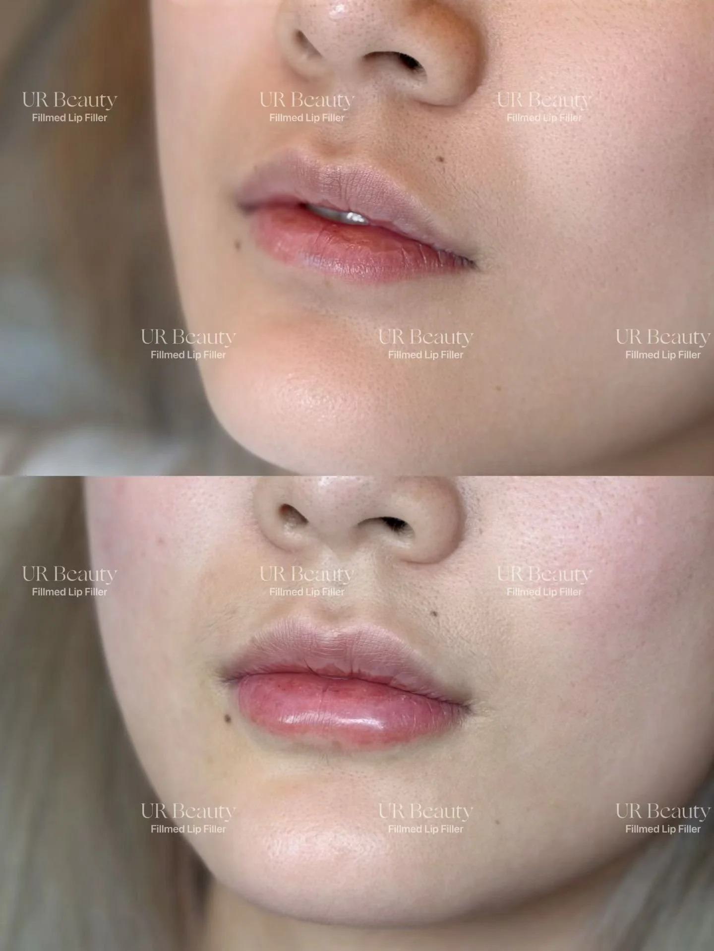 Real Patient Results | Lip FIllers