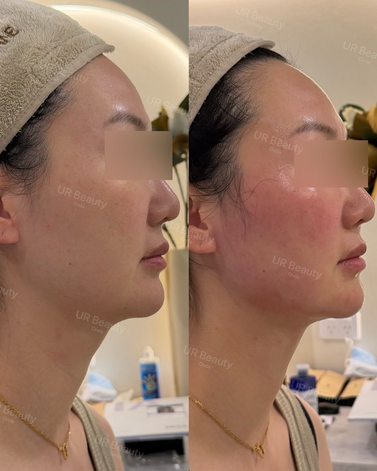Real Patient Results | ONDA Pro