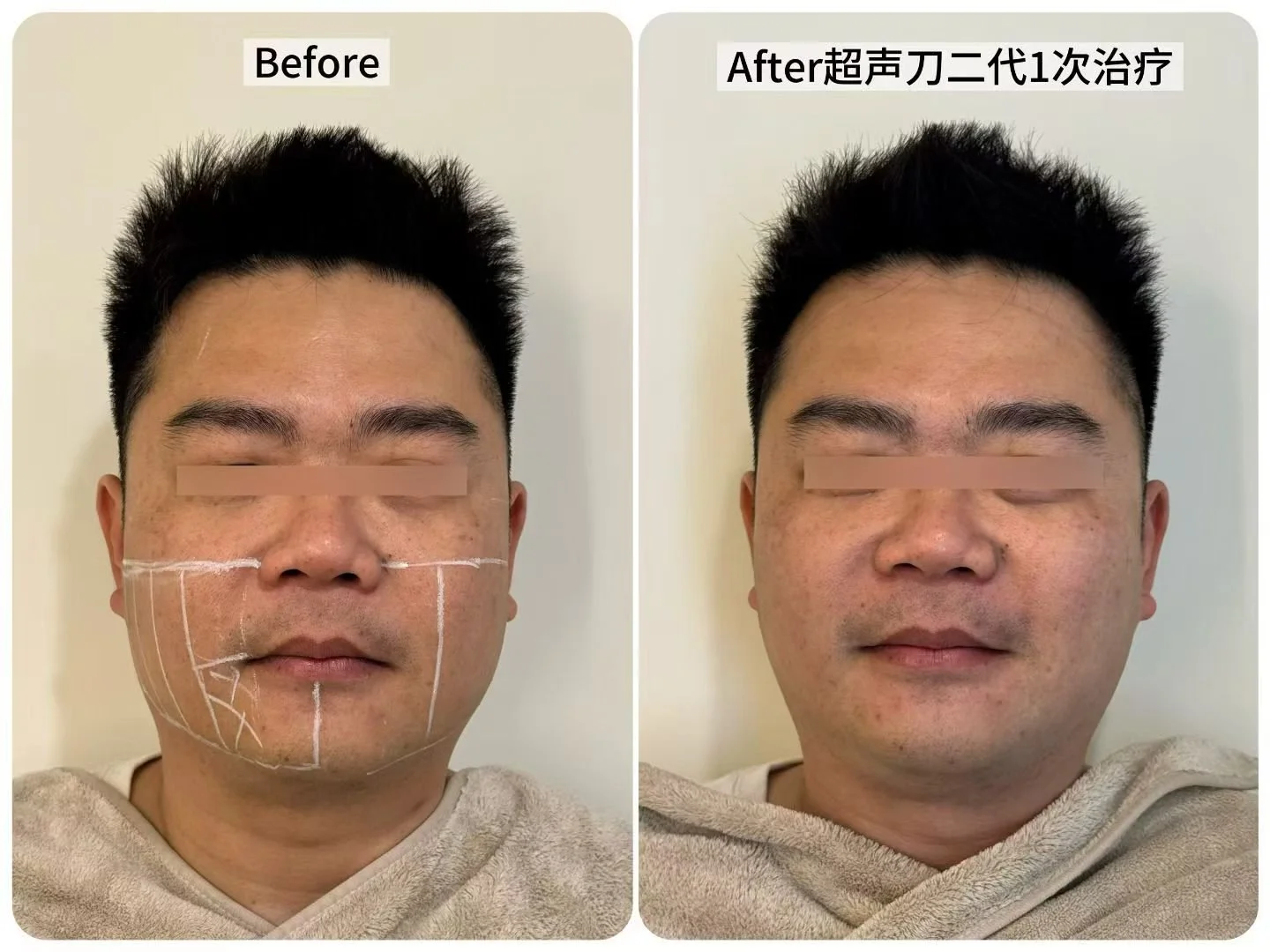 Real Patient Results | Ultherapy Prime