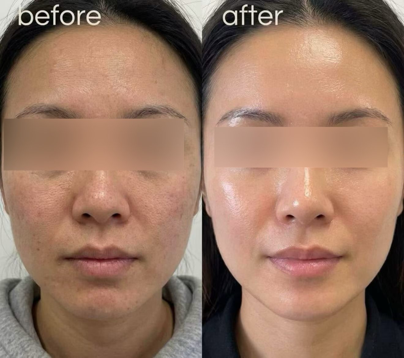 Real Patient Results | Skin Boosters