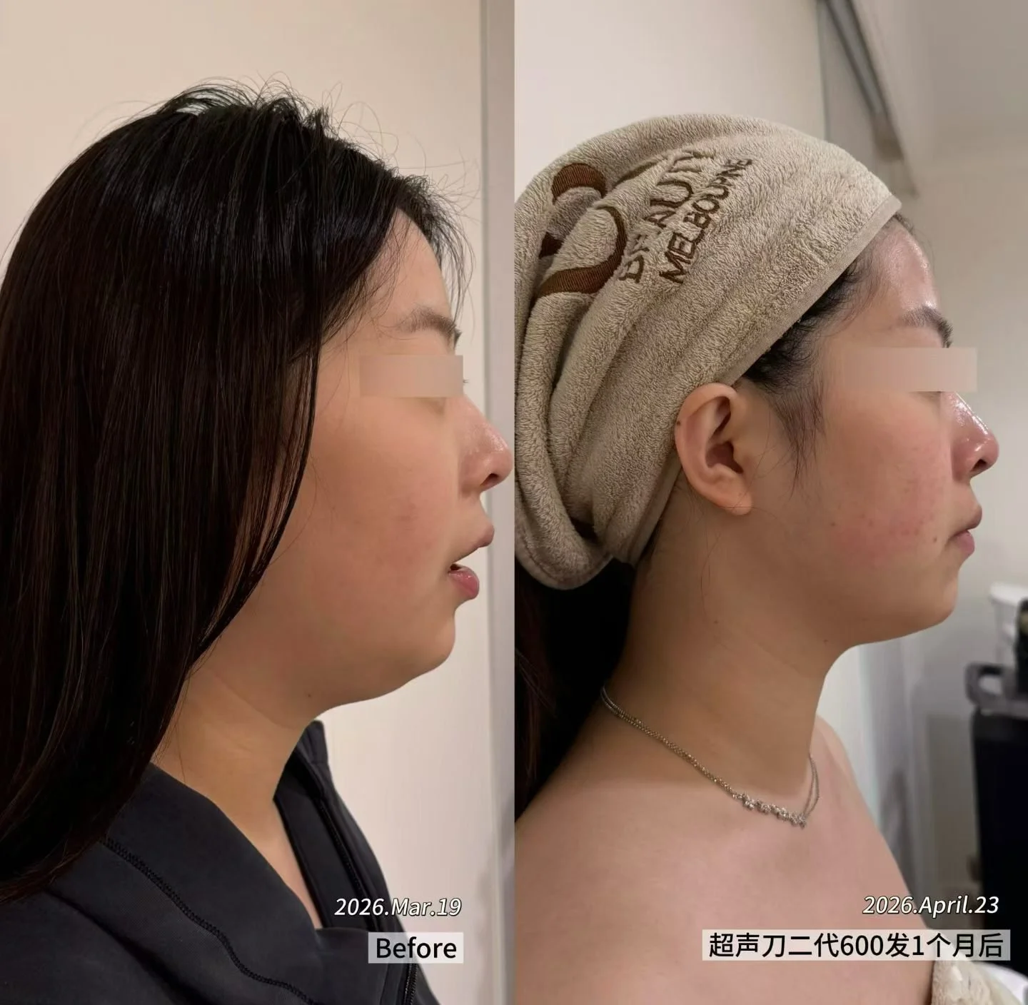 Real Patient Results | Ultherapy Prime