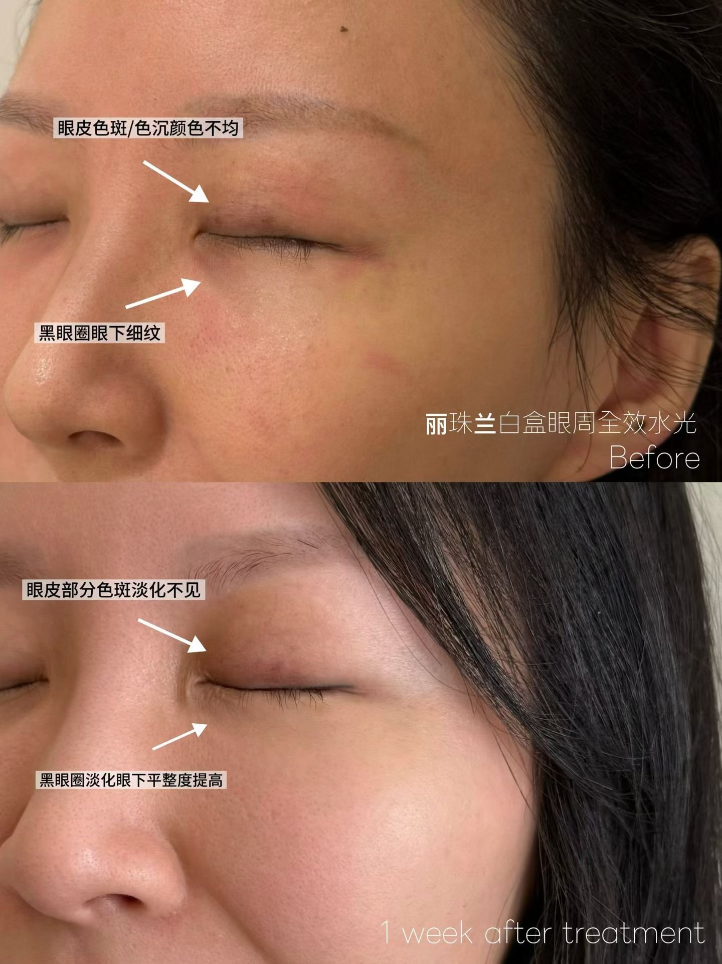 Real Patient Results | Skin Boosters