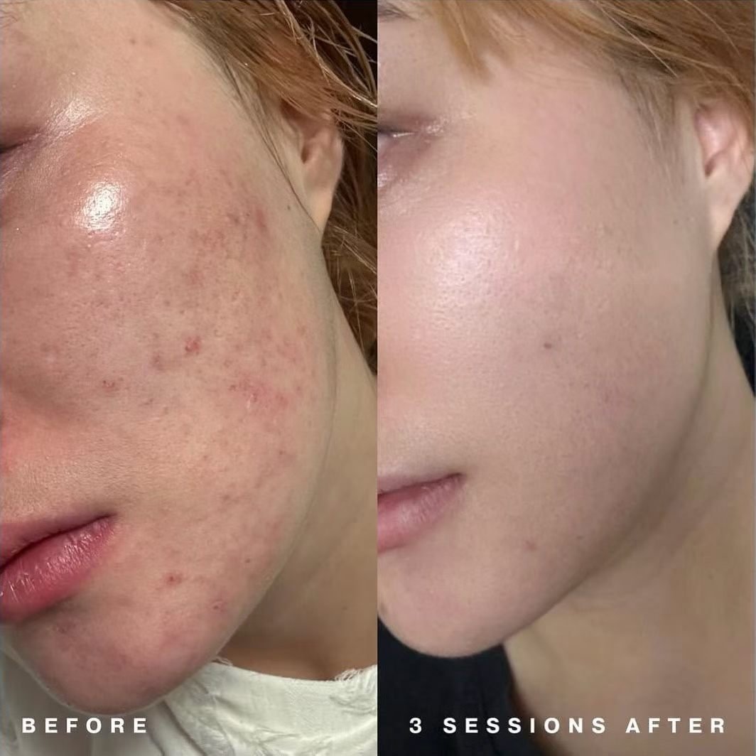 Real Patient Results | Skin Boosters