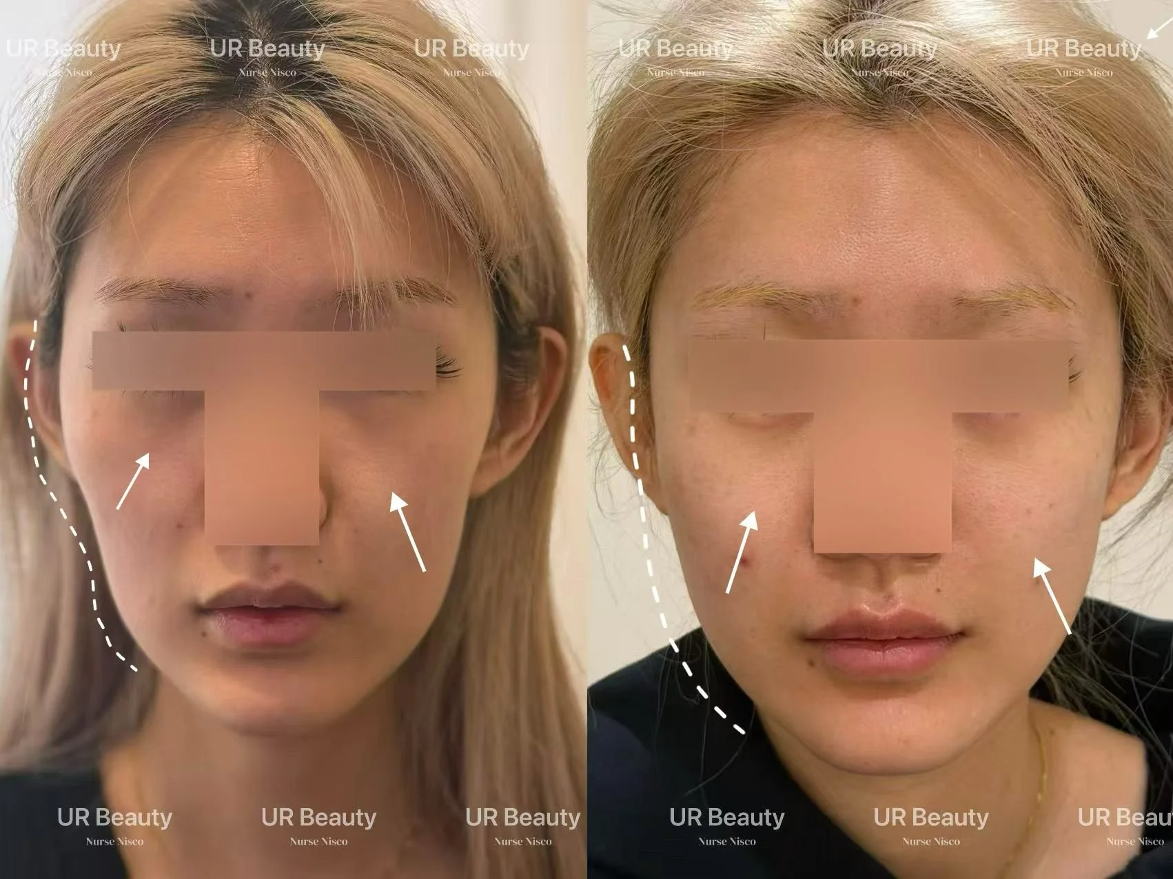 Real Patient Results | Dermal Fillers
