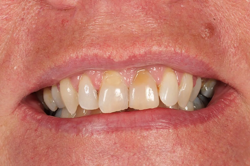 Pre-treatment Veneers and whitening