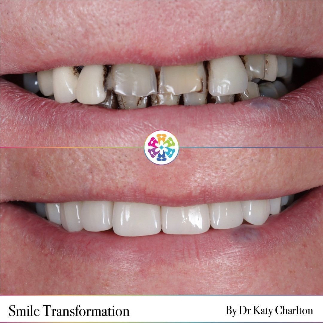 🌟 Smile Makeovers 🌟
As a team, we have over two decades of experience working in Dentistry.
While many patients are unhappy with their smiles for many years, it can often be a life event or comment from a grandchild that prompts a patient to take t