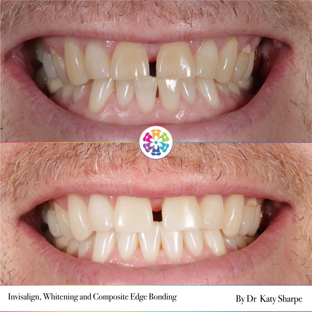 Let's talk about natural gaps in the front teeth - the gap is called a diastema.
While some patients like to close the gap, many prefer to keep it as it is part of their makeup and identity.
We take time to understand every patient's individual goals