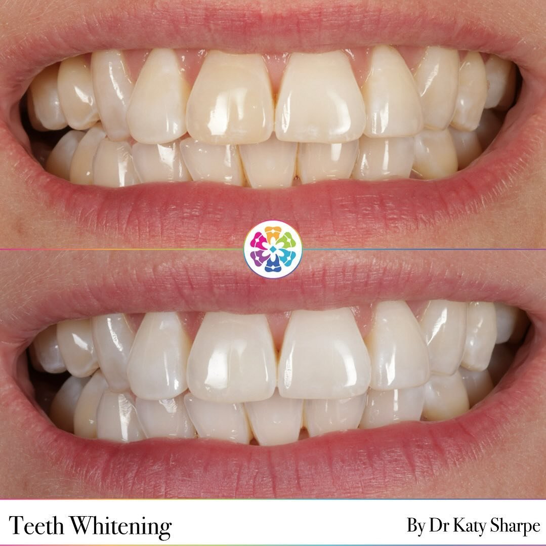 💎 Teeth Whitening 💎

At Dental Smiles, we use boutique whitening for easy, effective results ✨

With bespoke whitening trays and 4 tubes for whitening gel, that&rsquo;s all you need for a brighter smile 😆

Transform your smile effortlessly with at