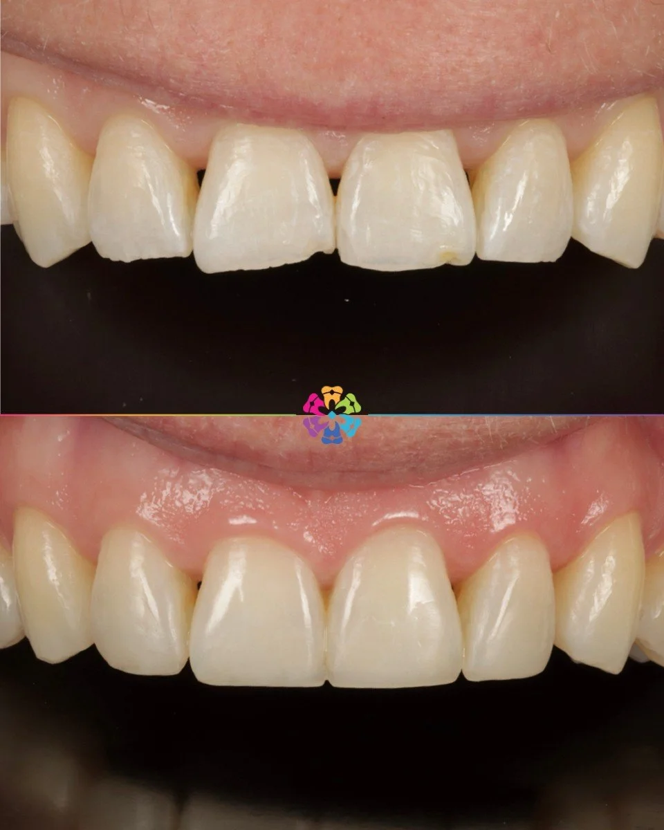 Composite Bonding ✨

Composite bonding is used for many reasons
- for aesthetics
- to prevent further damage to teeth
- to correct wear
- to mask stains or discolouration

This patient&rsquo;s teeth became worn due to her bite. After correctly the pa