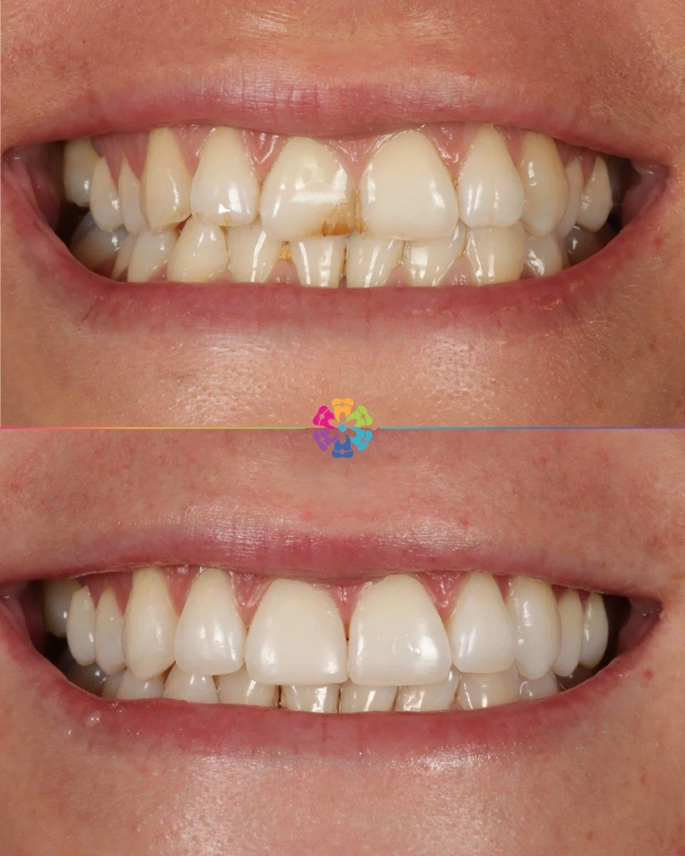 Transformation Time 🤩

The Case:
- Upper Invisalign
- Whitening
- Composite Edge Bonding

What a fantastic result!! 🌟

Did you know we offer free consultations for Invisalign at Dental Smiles Flagstaff?

Get in touch now to start your dream smile j
