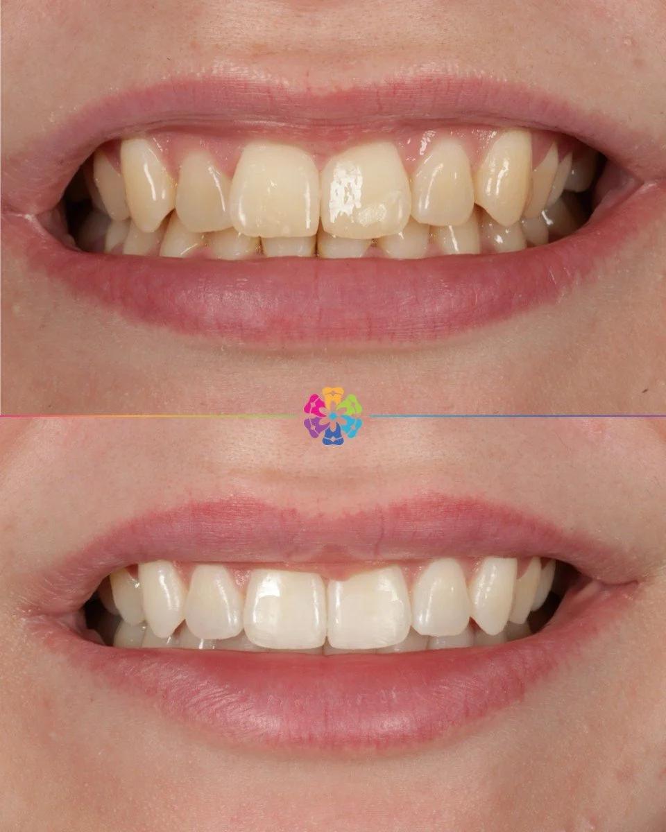 Invisalign, Whitening &amp; Composite Edge Bonding ✨

#dentalsmiles #dentalsmilesflagstaff #dentalsmilesessex #flagstaffcolchester #colchesterdentist #dedicatednervouspatients #naturalsmile #nervous #sedation #teethwhitening #nervouspatient #dentist 
