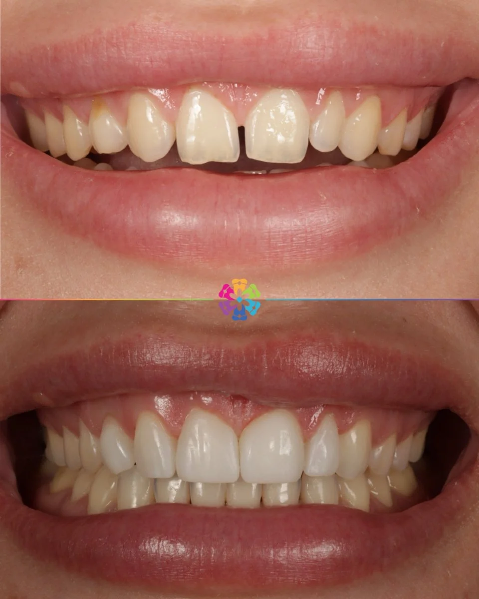 Composite Veneers 💫
Same day results - because confidence shouldn’t have to wait 😁
Natural and flawless look by Dr Katy Sharpe🦷
#dentalsmiles #dentalsmilesflagstaff #dentalsmilesessex #flagstaffcolchester #colchesterdentist #dedicatednerv