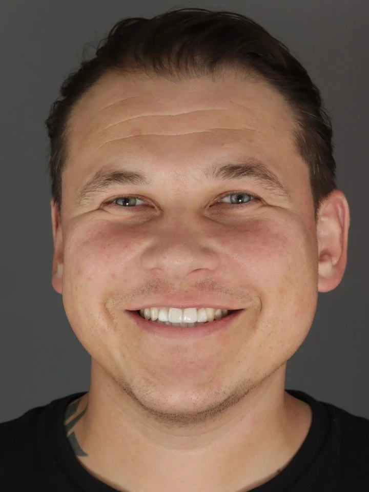 Smile Transformation 💫
What’s involved?
- Invisalign
- Whitening
- Crown Replacement (UR2)
- Porcelain Veneers (UR1 & UL1)
- Zirconia Maryland with white wing (UL2)
Transforming smiles, transforming confidence ✨
#dentalsmiles #dentalsmi