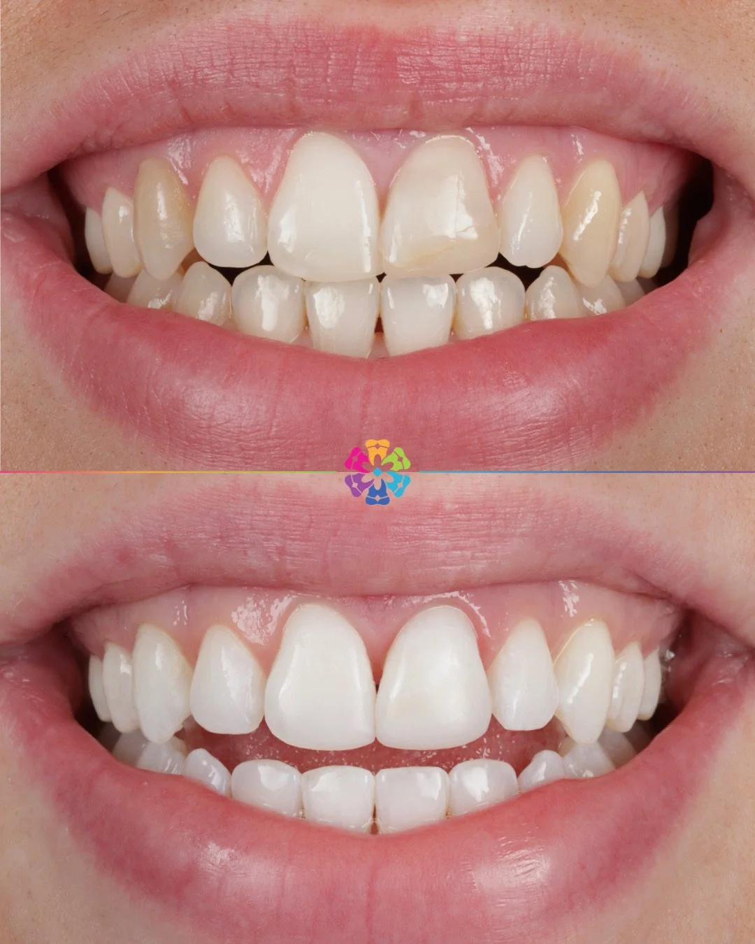 Non Vital Tooth Whitening 🦷

This patient had an accident as a child and broke their front tooth which can lead to the nerve dying off in the future and the tooth appearing darker

To solve this, Dr Katy Sharpe internally whitened this tooth and als