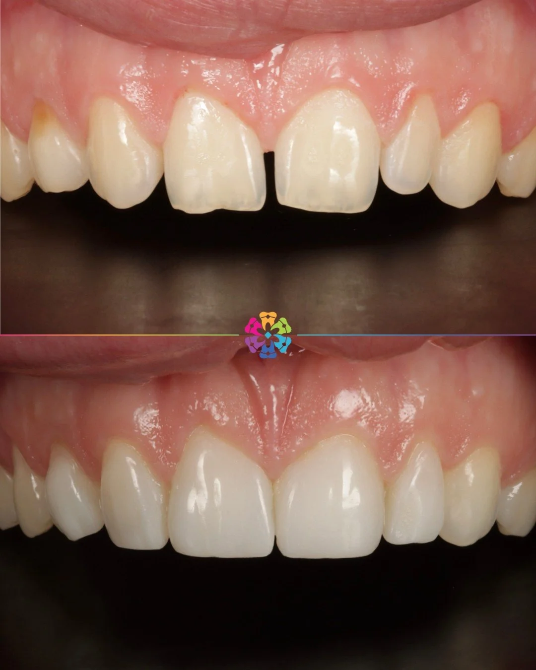 Composite Veneers- an incredible transformation ✨

Dentistry = science &amp; art 🥼🎨

#dentalsmiles #dentalsmilesflagstaff #dentalsmilesessex #flagstaffcolchester #colchesterdentist #dedicatednervouspatients #naturalsmile #nervous #sedation #teethwh