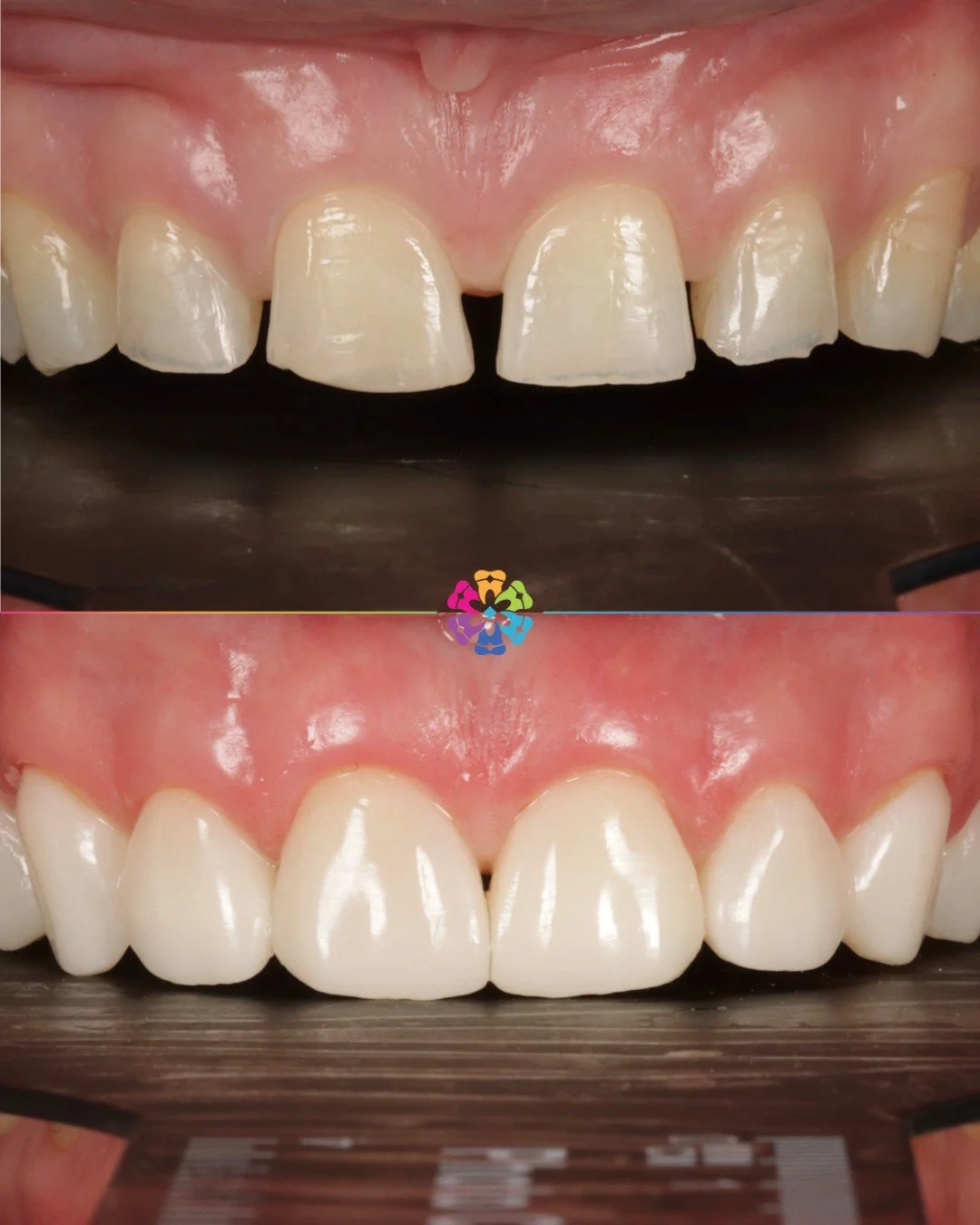 Composite Veneers ✨

#dentalsmiles #dentalsmilesflagstaff #dentalsmilesessex #flagstaffcolchester #colchesterdentist #dedicatednervouspatients #naturalsmile #nervous #sedation #teethwhitening #nervouspatient #dentist #smile #cosmeticdentistry #veneer