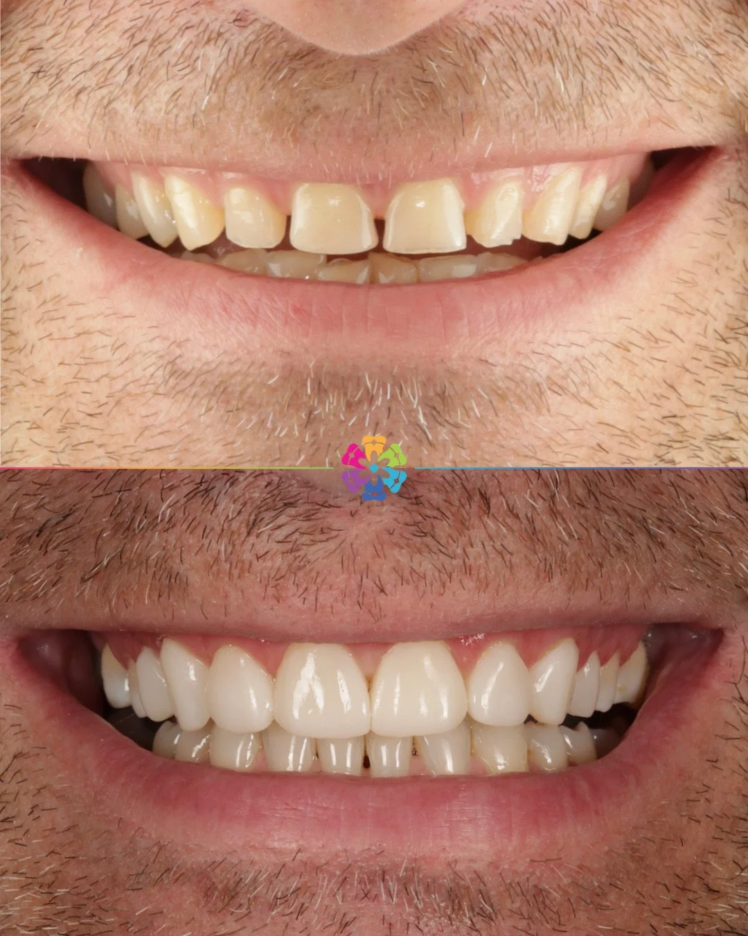 This patient wanted to resolve the lower crowding and wear and spacing on the upper teeth 🦷

Dr Katy Sharpe used Invisalign to align the teeth, then used whitening to brighten ⭐️

Composite veneers were done on the upper 4-4 teeth!

#dentalsmiles #d