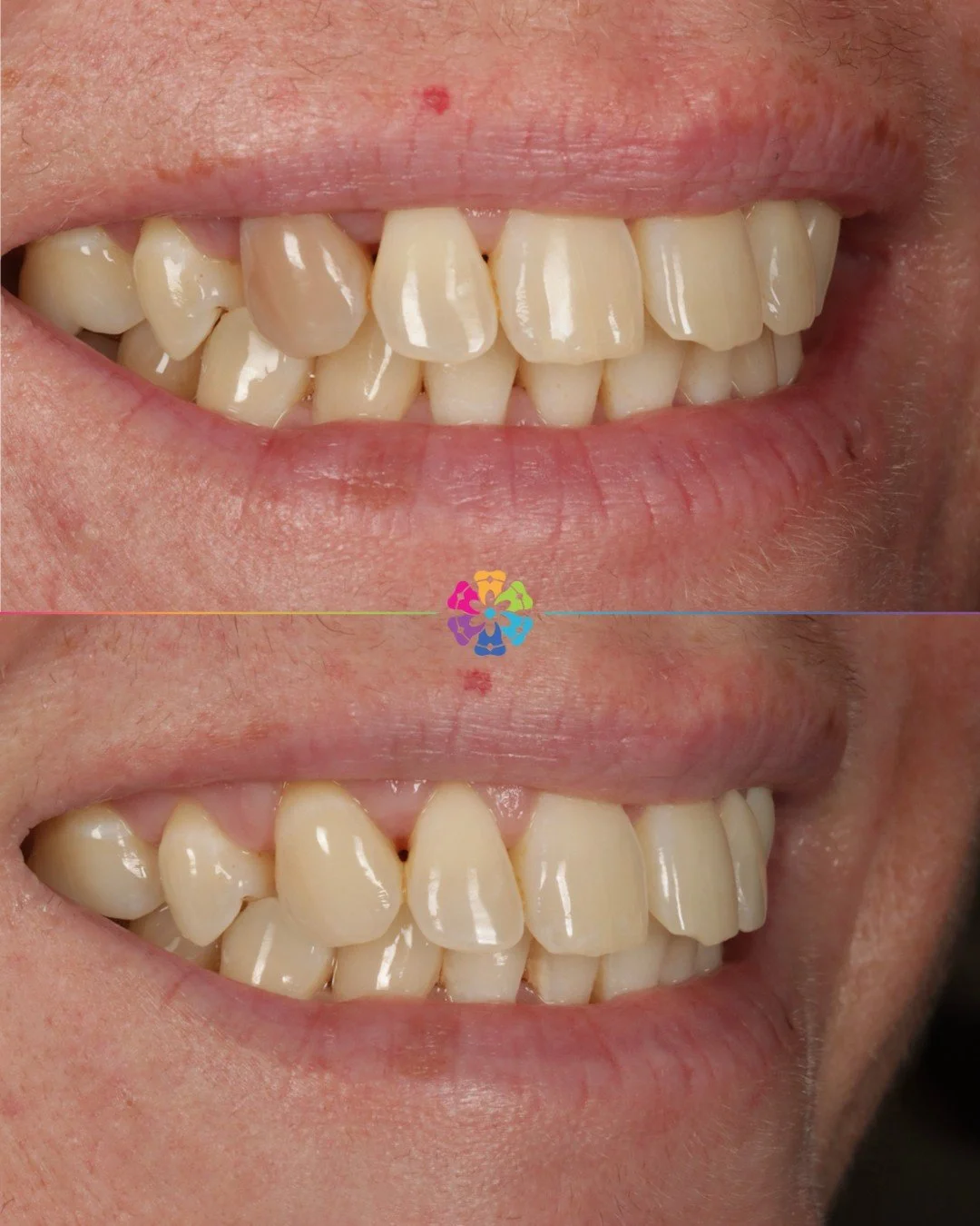Inside Outside Whitening 🌟 

#dentalsmiles #dentalsmilesflagstaff #dentalsmilesessex #flagstaffcolchester #colchesterdentist #dedicatednervouspatients #naturalsmile #nervous #sedation #teethwhitening #nervouspatient #dentist #smile #cosmeticdentistr