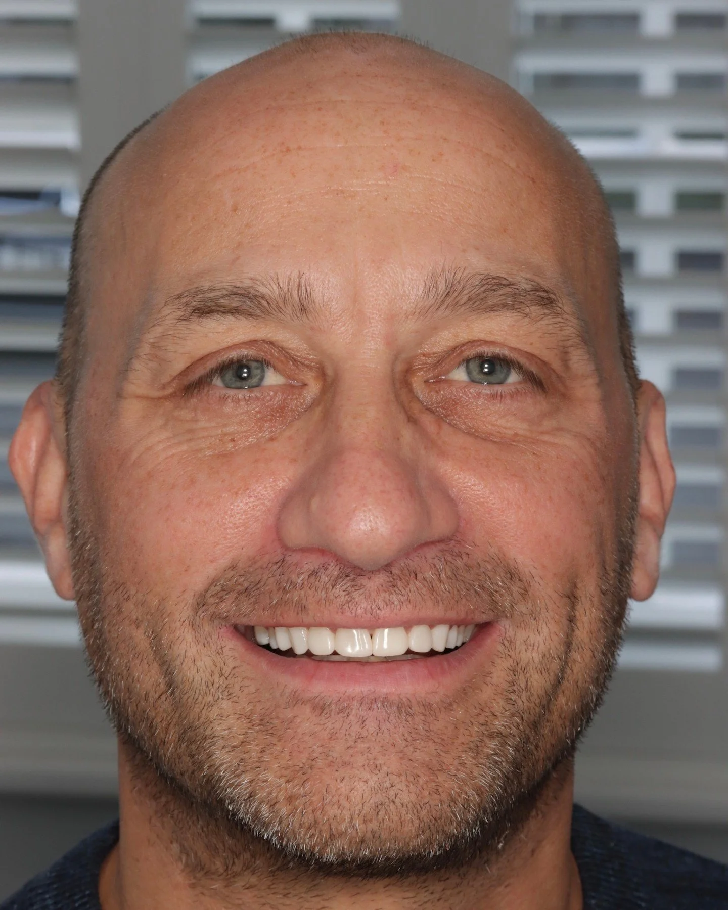 Smile Makeover 🌟

Incredible results by Dr Katy Sharpe 

#dentalsmiles #dentalsmilesflagstaff #dentalsmilesessex #flagstaffcolchester #colchesterdentist #dedicatednervouspatients #naturalsmile #nervous #sedation #teethwhitening #nervouspatient #dent