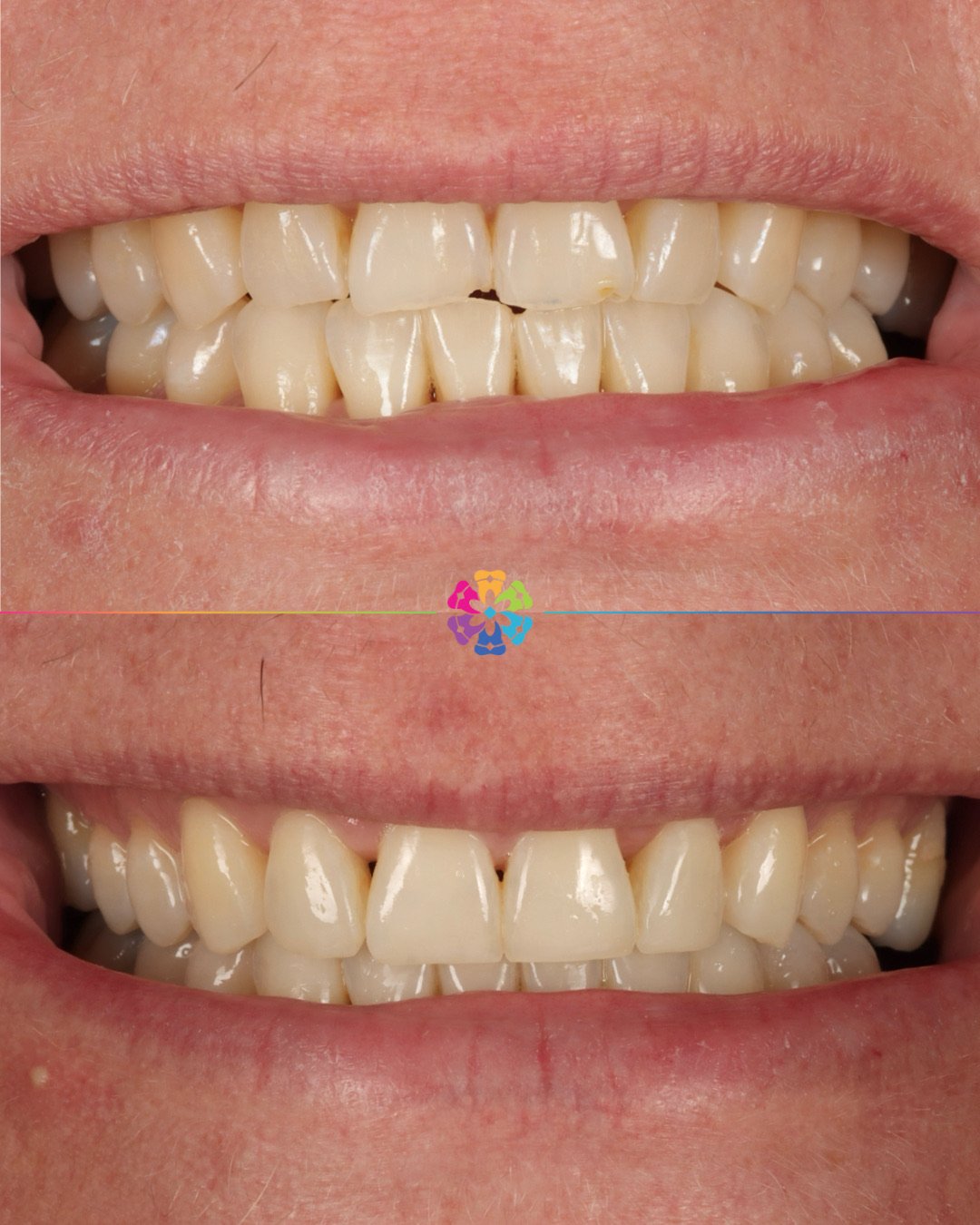 Deprogrammer, Invisalign &amp; Composite Bonding 🦷🦷

A deprogrammer is a removable appliance that you wear for a couple of weeks. It stops you biting in your normal position and so allows your jaw joint to relax/ deprogramme. The teeth can then be 