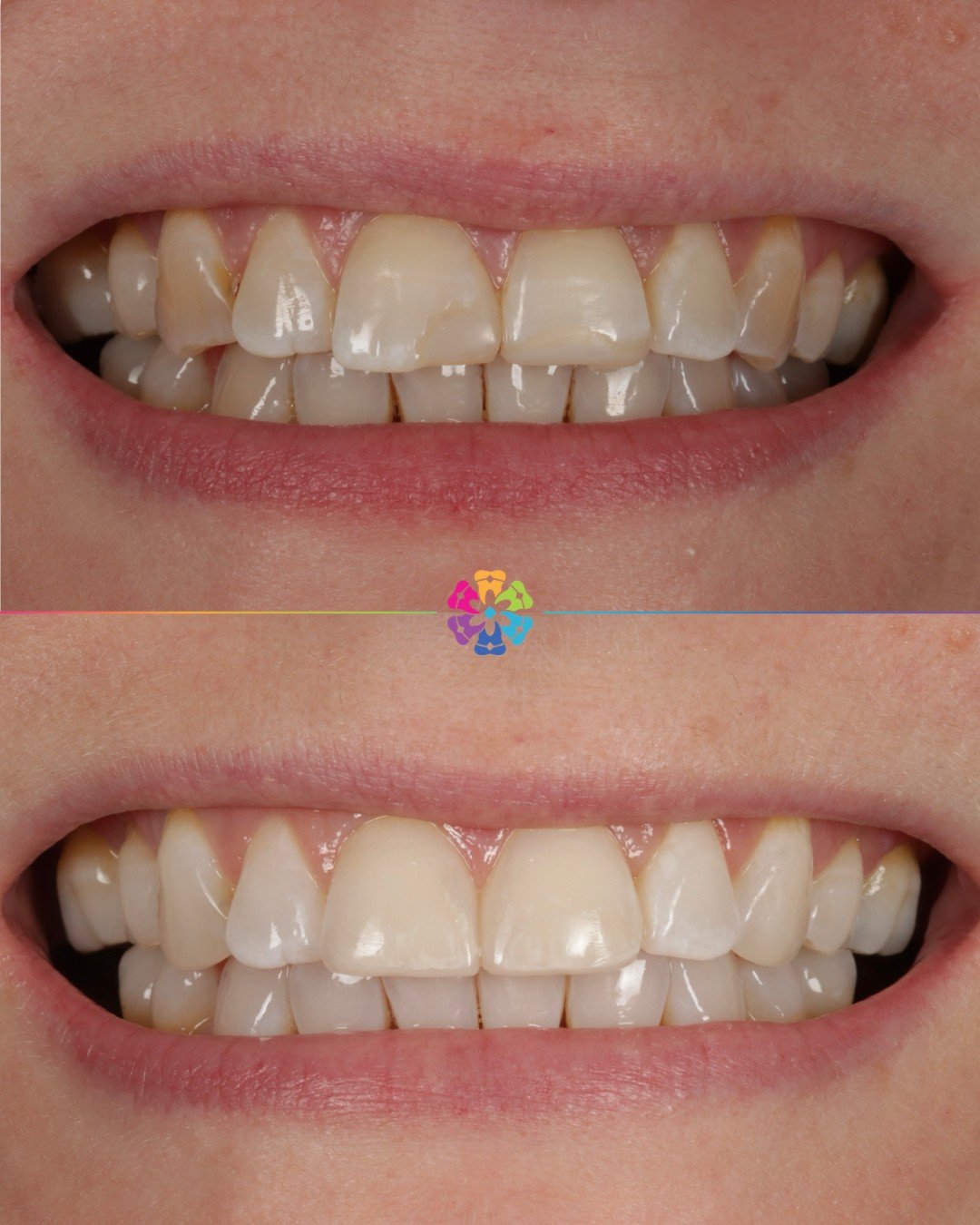 Whitening &amp; Replacement Composites ✨

Dr Katy Sharpe used boutique whitening to brighten the smile and then replaced the old composite fillings

Natural, lasting results 🦷

#dentalsmiles #dentalsmilesflagstaff #dentalsmilesessex #flagstaffcolche