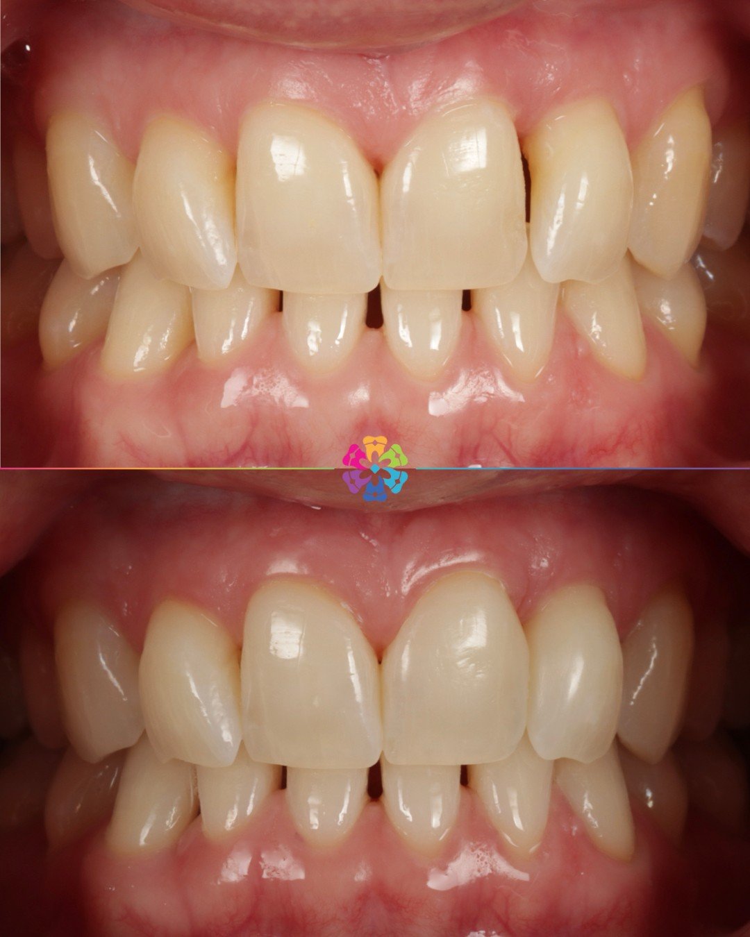 Whitening &amp; Composite Bonding to close the space between the upper incisor and lateral incisor 🦷

#dentalsmiles #dentalsmilesflagstaff #dentalsmilesessex #flagstaffcolchester #colchesterdentist #dedicatednervouspatients #naturalsmile #nervous #s
